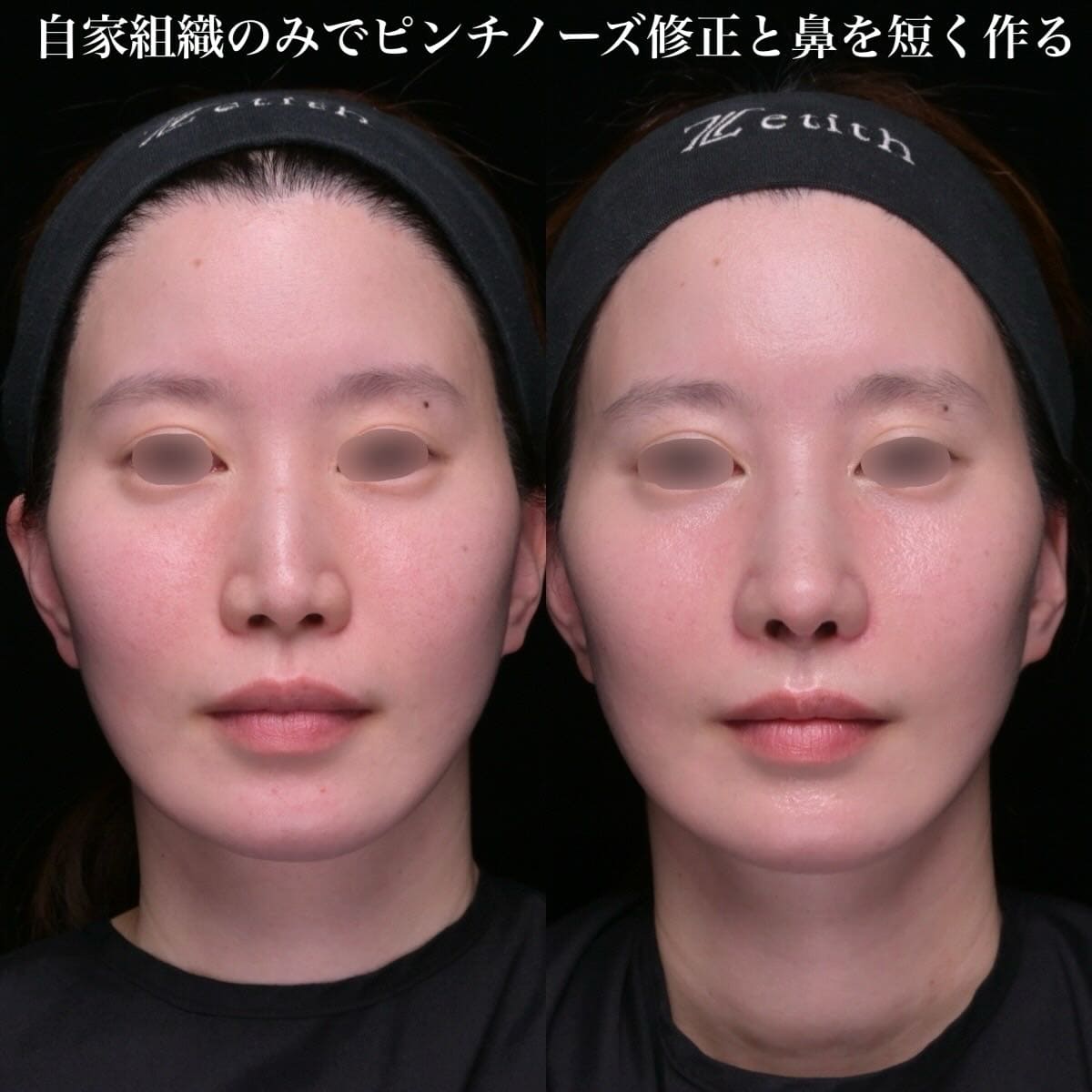 鼻整形のビフォーアフター写真(術前)