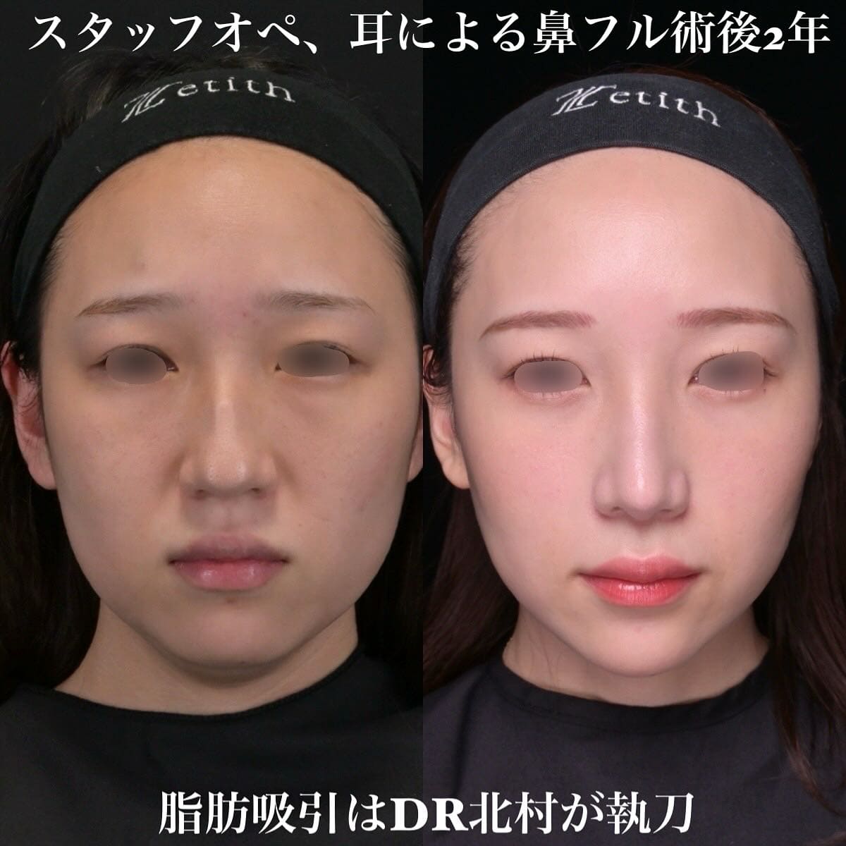 鼻整形のビフォーアフター写真(術前)
