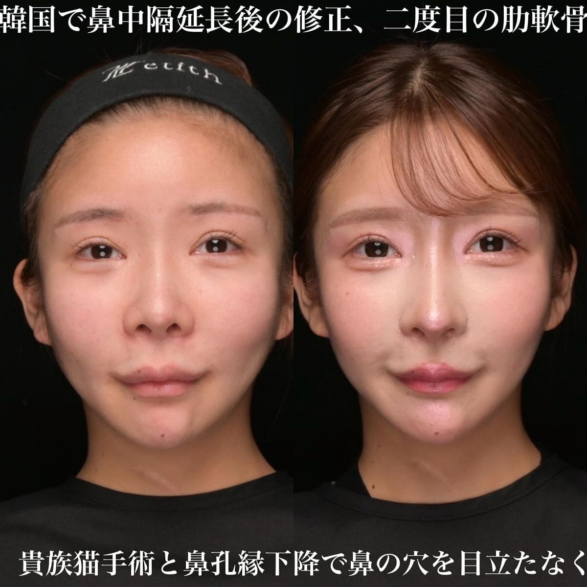 鼻整形のビフォーアフター写真(術前)