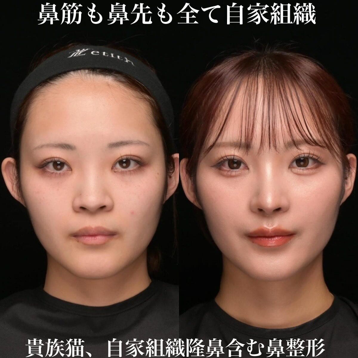 鼻整形のビフォーアフター写真(術前)