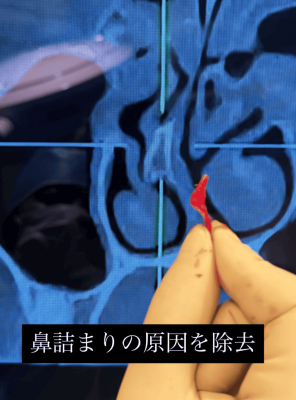 鼻づまり