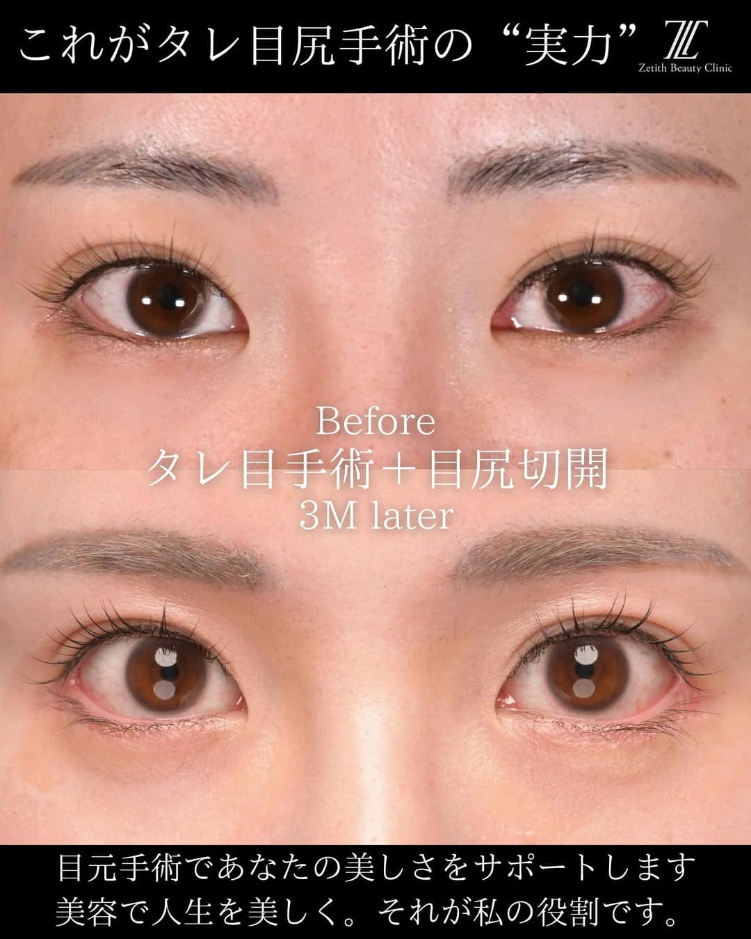 タレ目整形のビフォーアフター写真(術前)