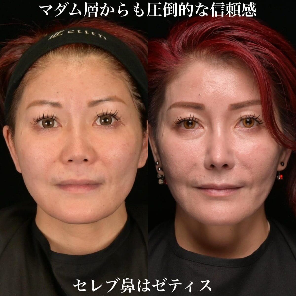 鼻整形のビフォーアフター写真(術前)