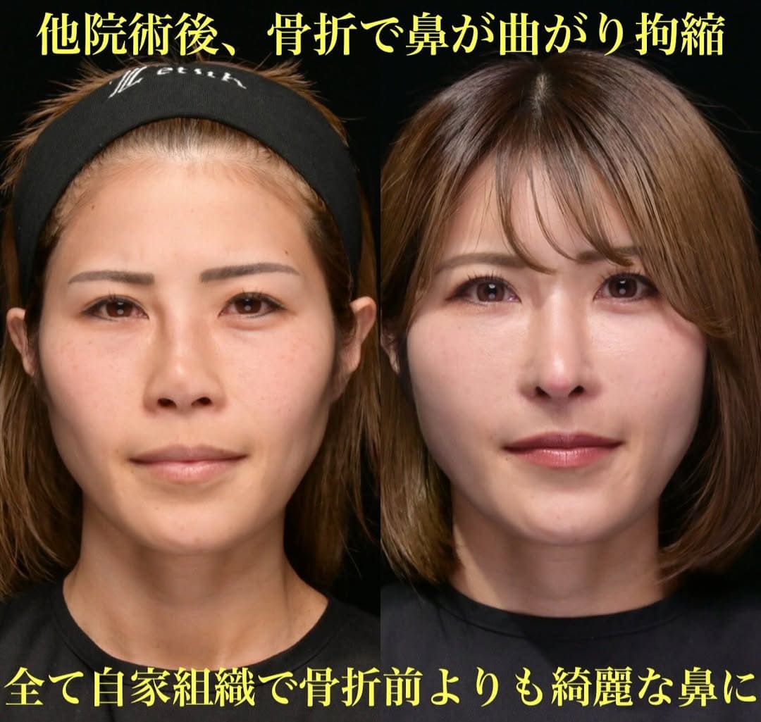 鼻整形のビフォーアフター写真(術前)