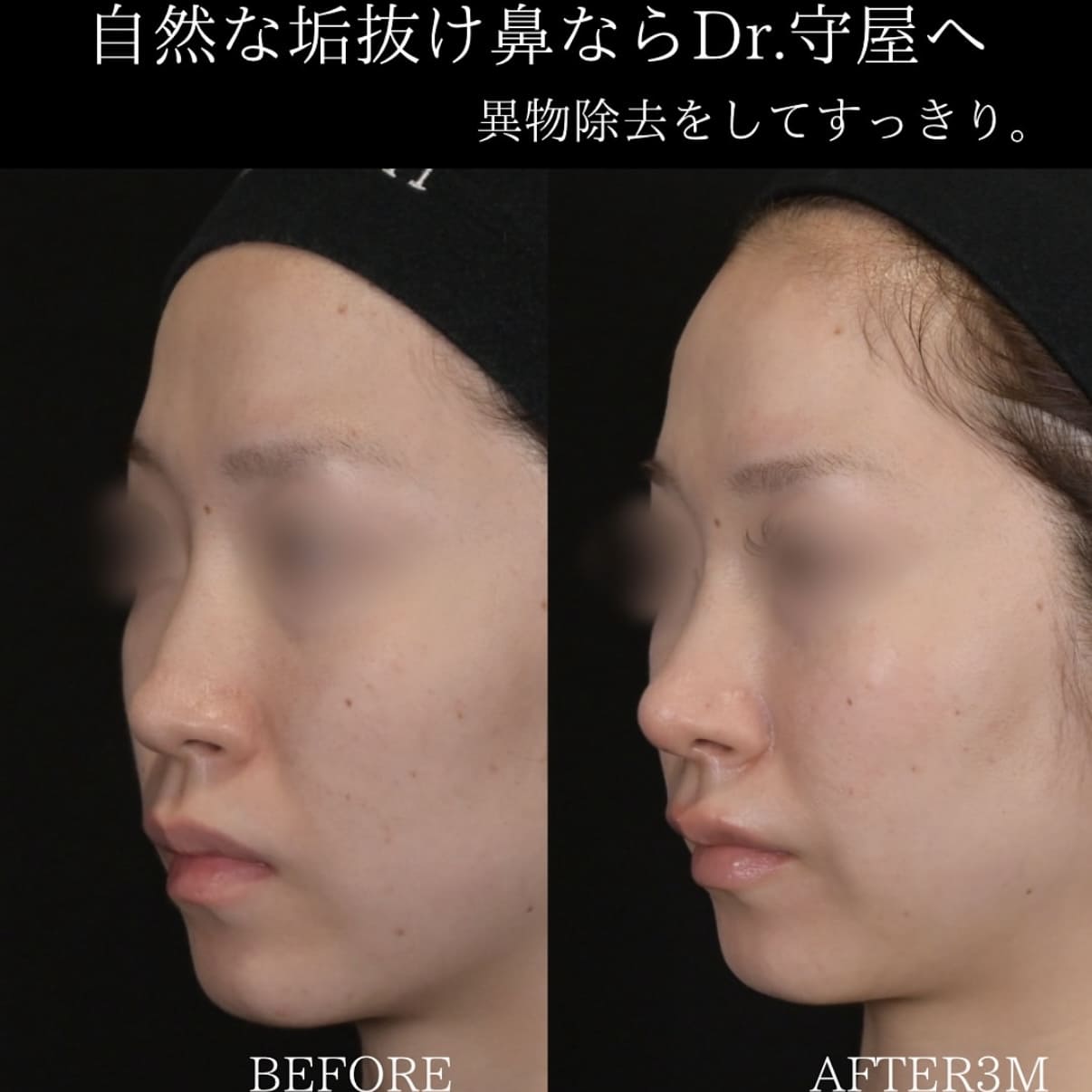 鼻整形のビフォーアフター写真