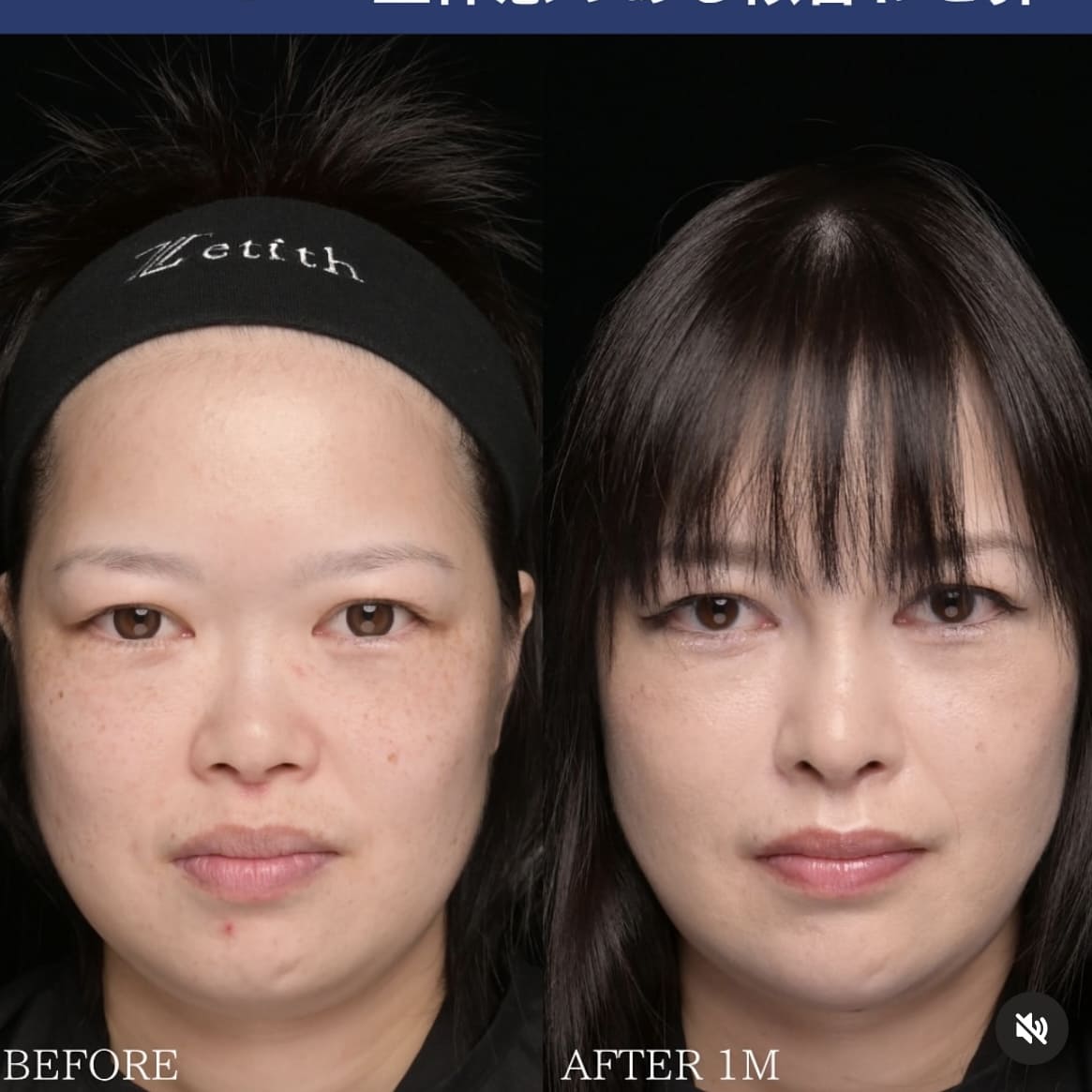 鼻整形のビフォーアフター写真
