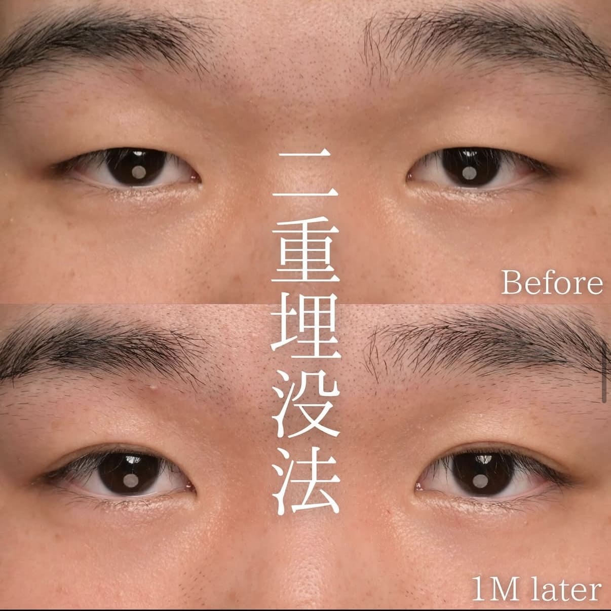 目元整形のビフォーアフター写真