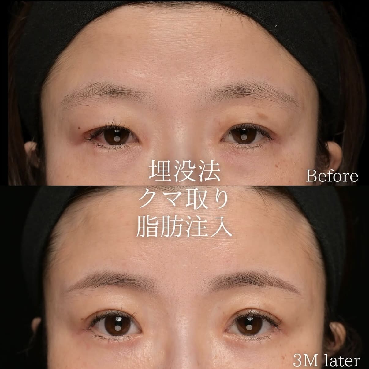 目元整形のビフォーアフター写真
