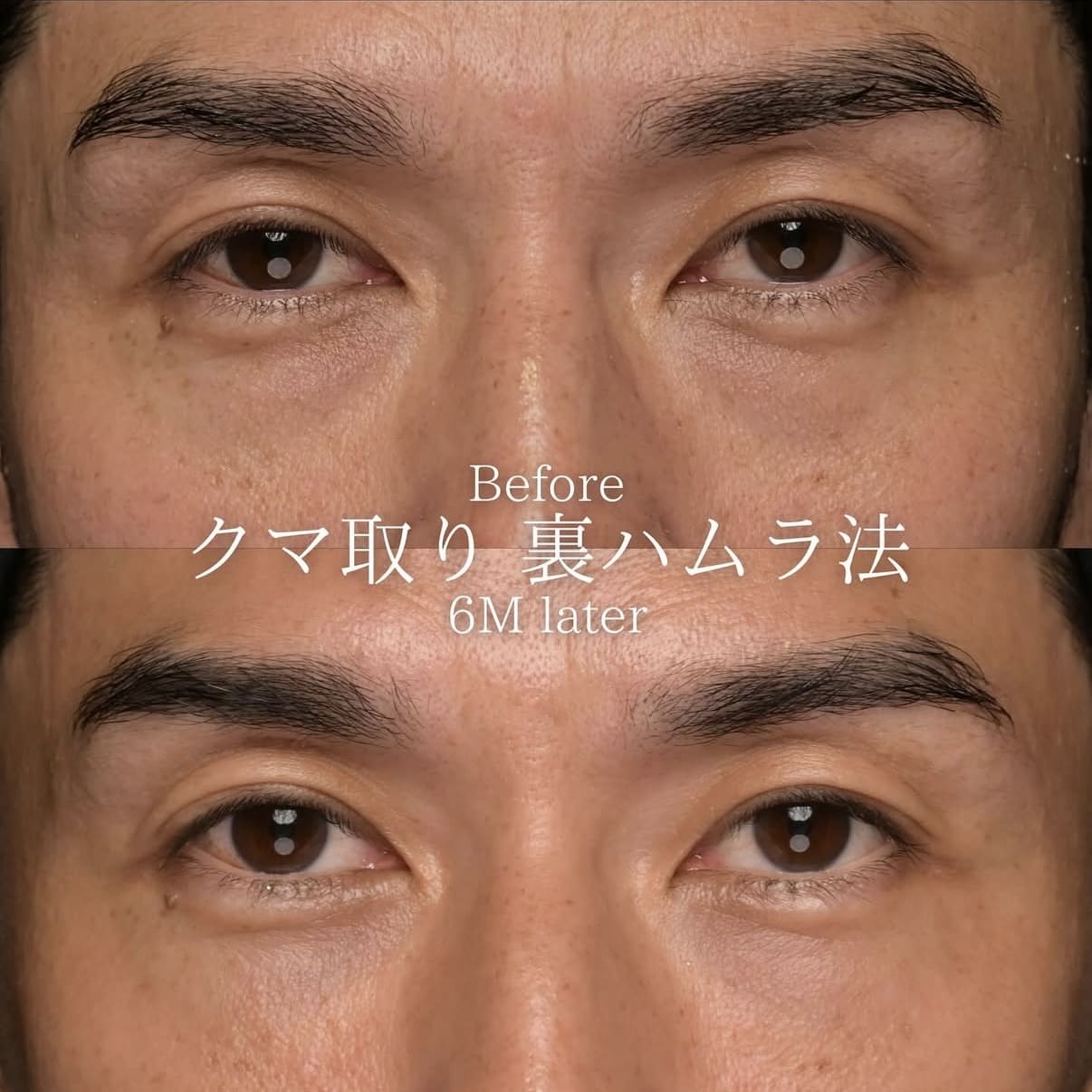 目元整形のビフォーアフター写真
