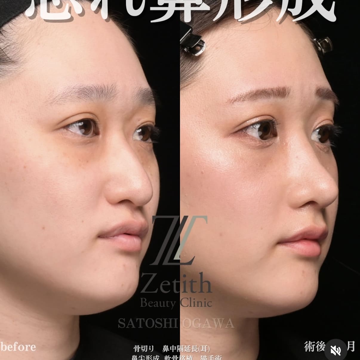 鼻整形のビフォーアフター写真