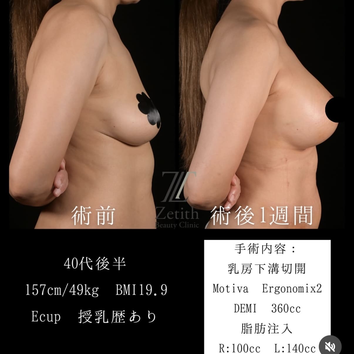 豊胸術のビフォーアフター写真