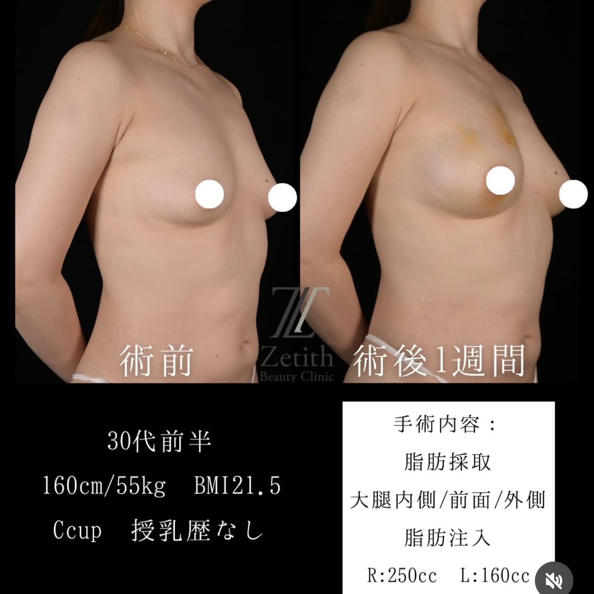 豊胸術のビフォーアフター写真