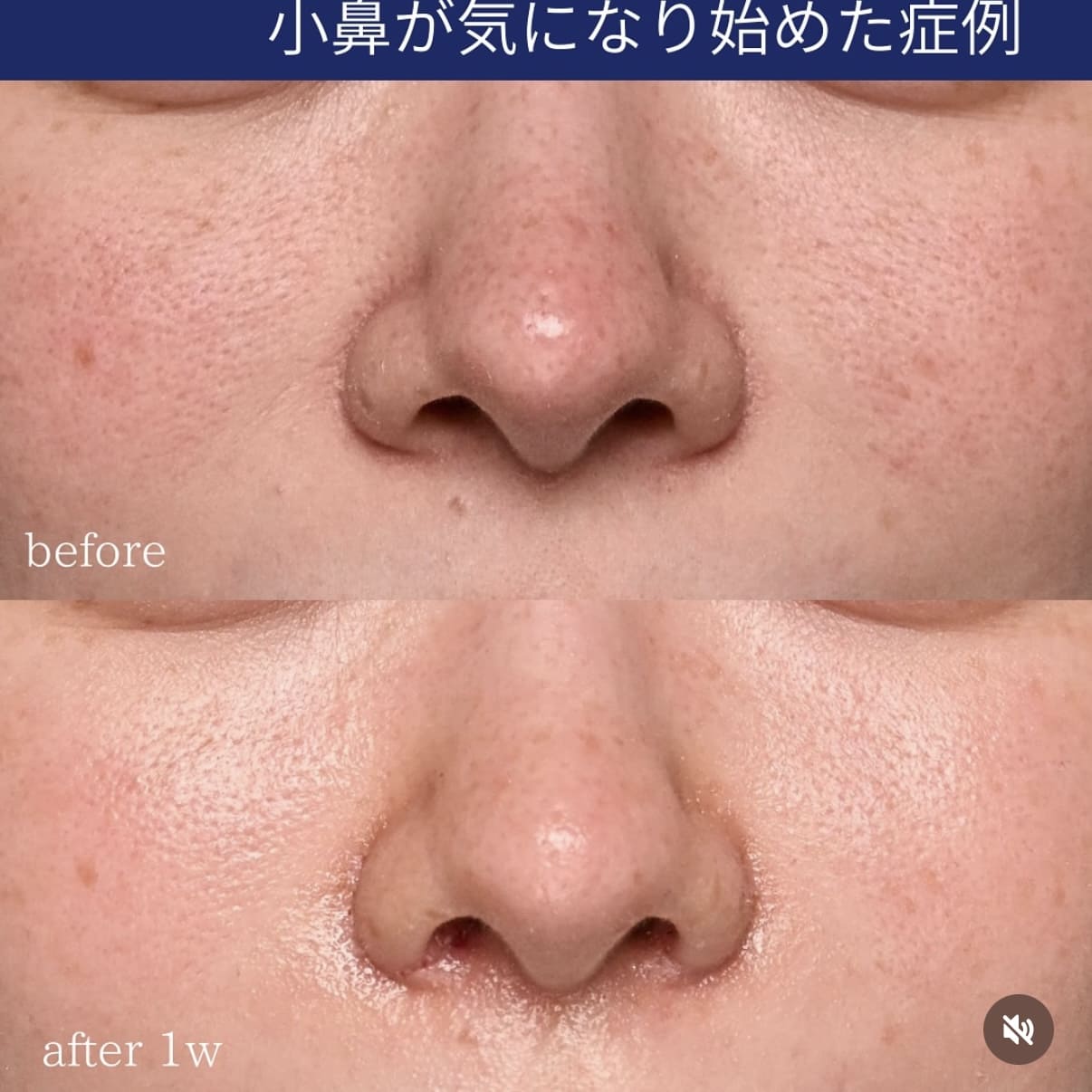 鼻整形のビフォーアフター写真