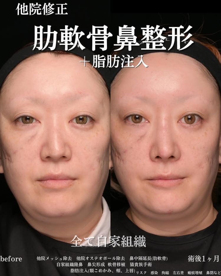 鼻整形のビフォーアフター写真(術前)