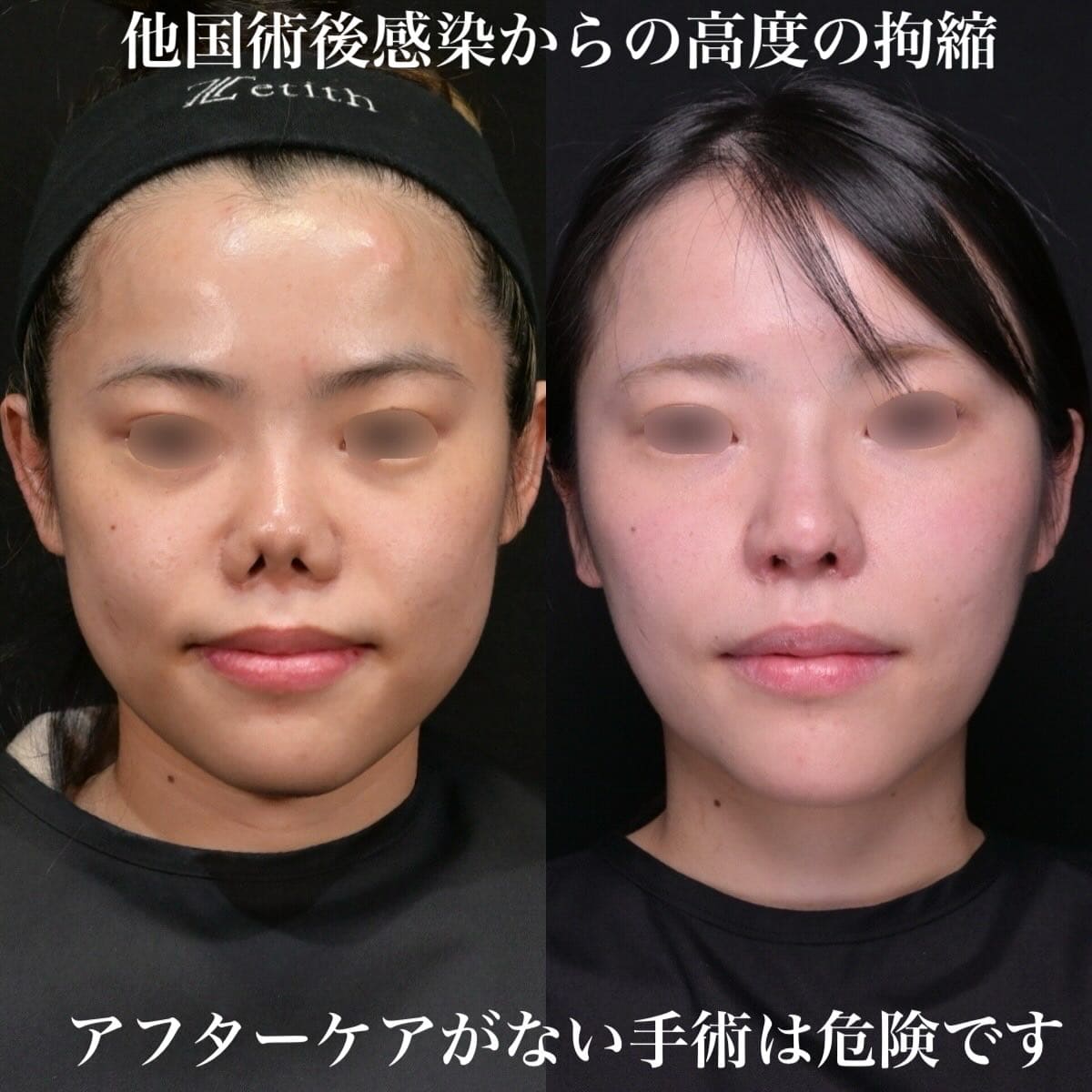 鼻整形のビフォーアフター写真(術前)