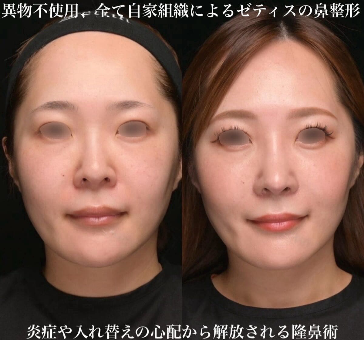 鼻整形のビフォーアフター写真(術前)