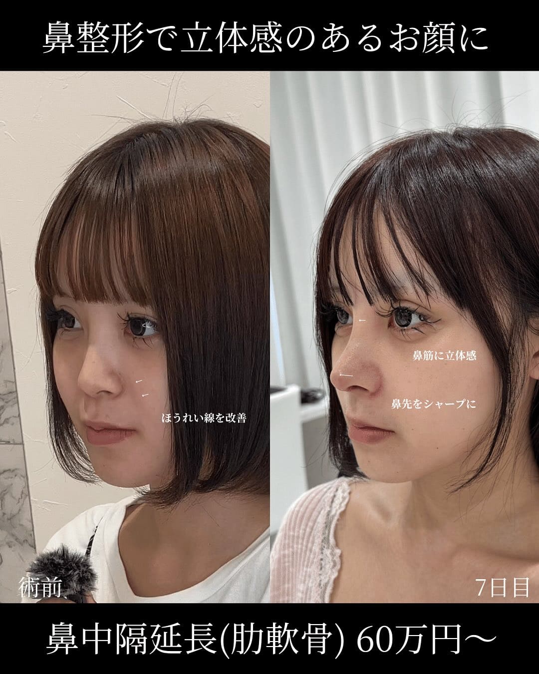 鼻整形のビフォーアフター写真(術前)
