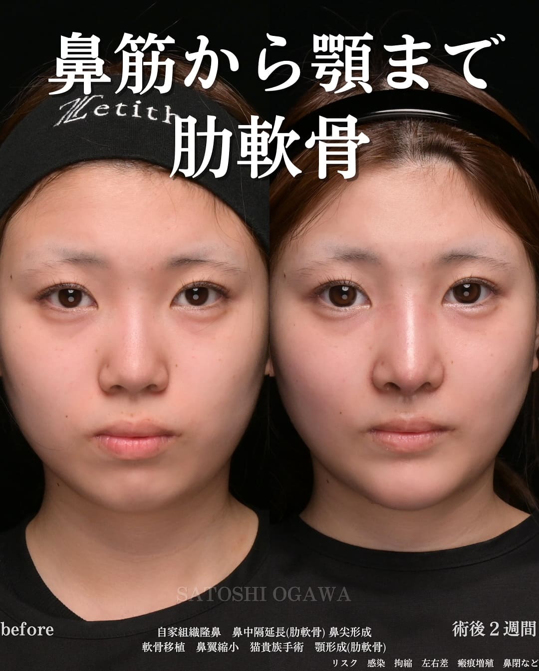鼻整形のビフォーアフター写真(術前)