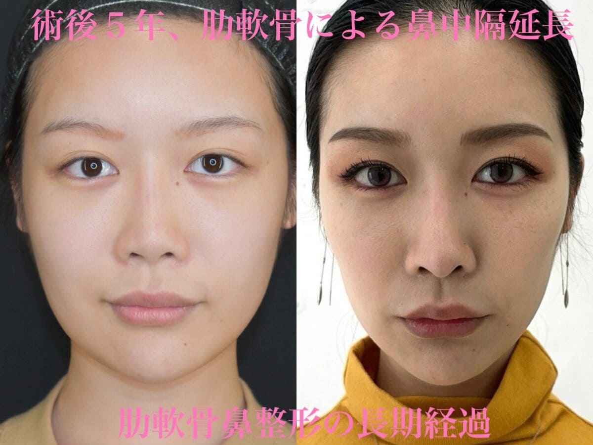 鼻整形のビフォーアフター写真(術前)
