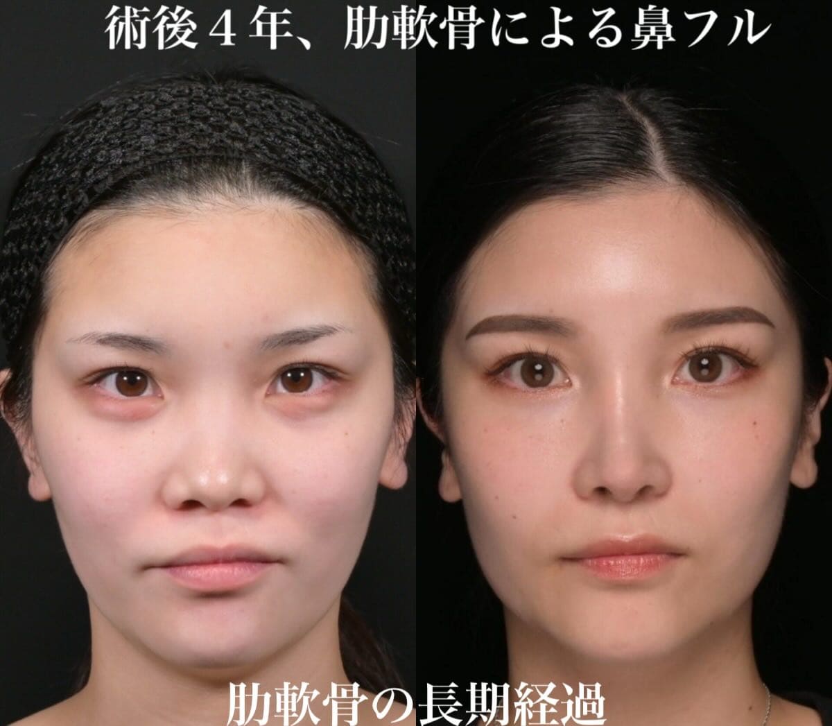 鼻整形のビフォーアフター写真(術前)
