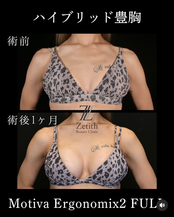 豊胸術のビフォーアフターの写真