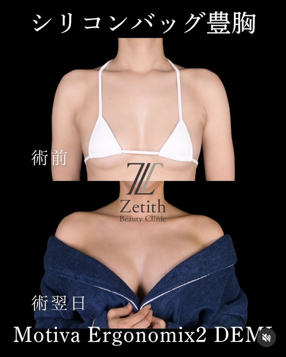 豊胸術のビフォーアフターの写真
