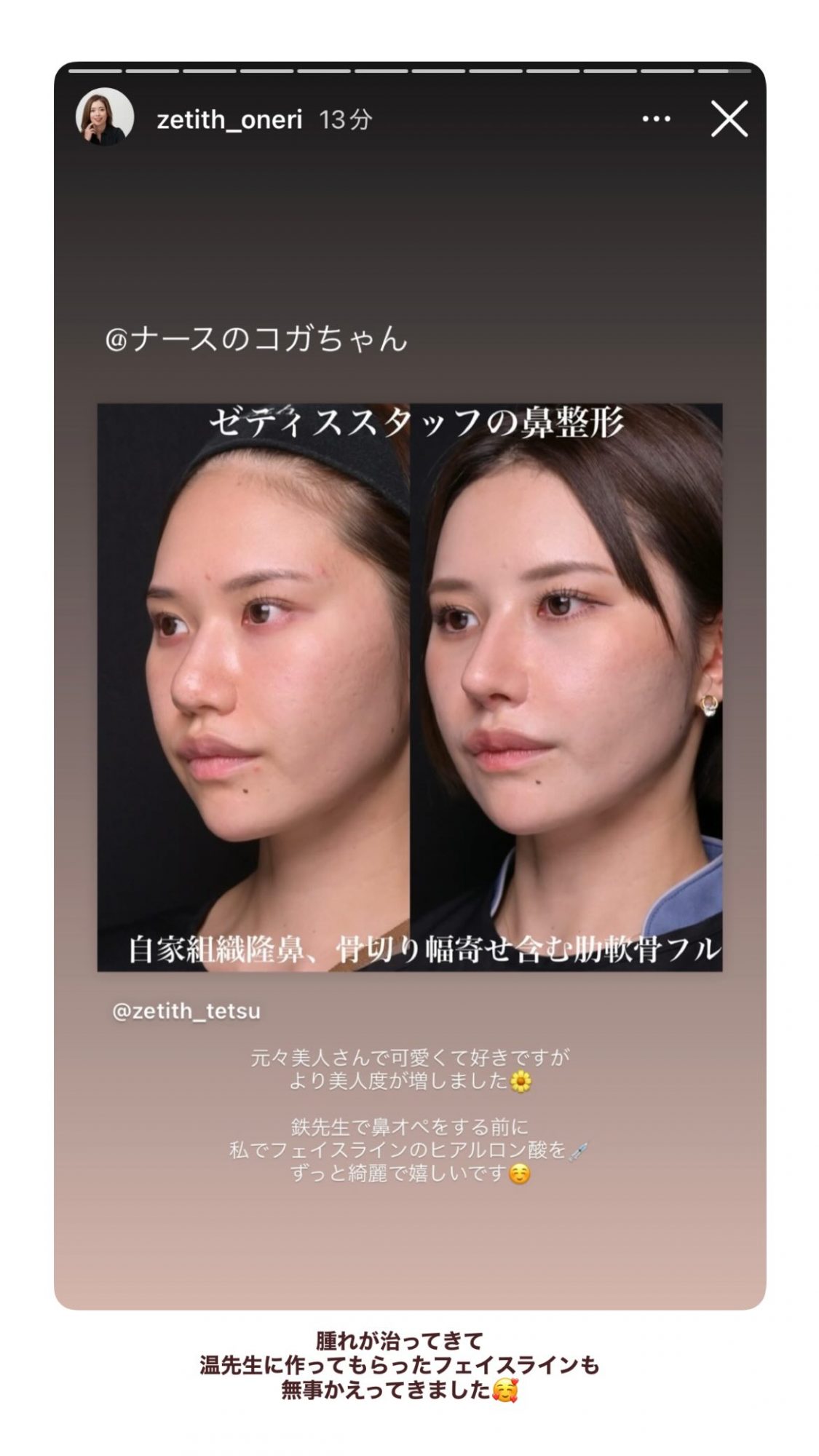鼻整形1か月後