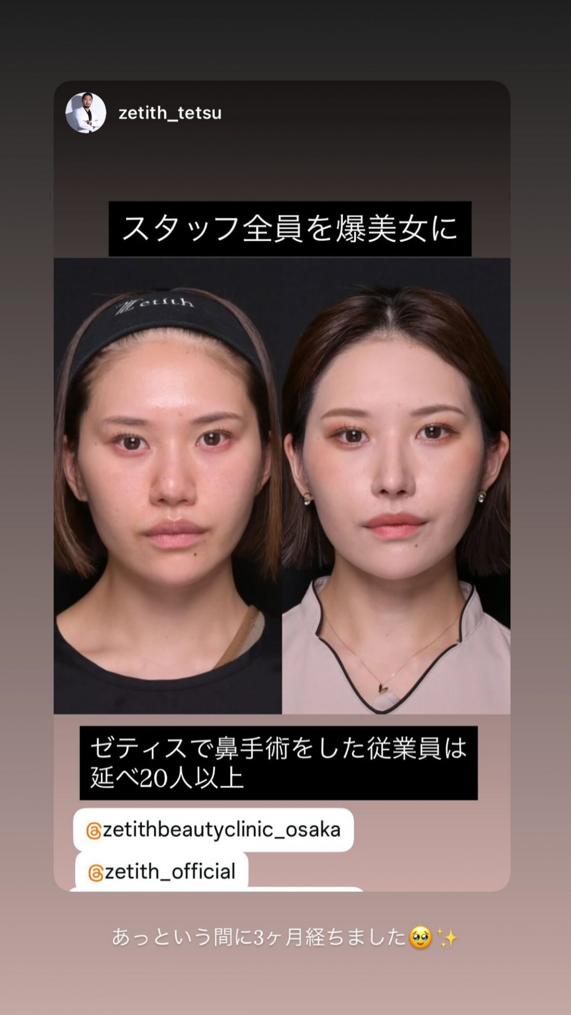 鼻整形3ヶ月後