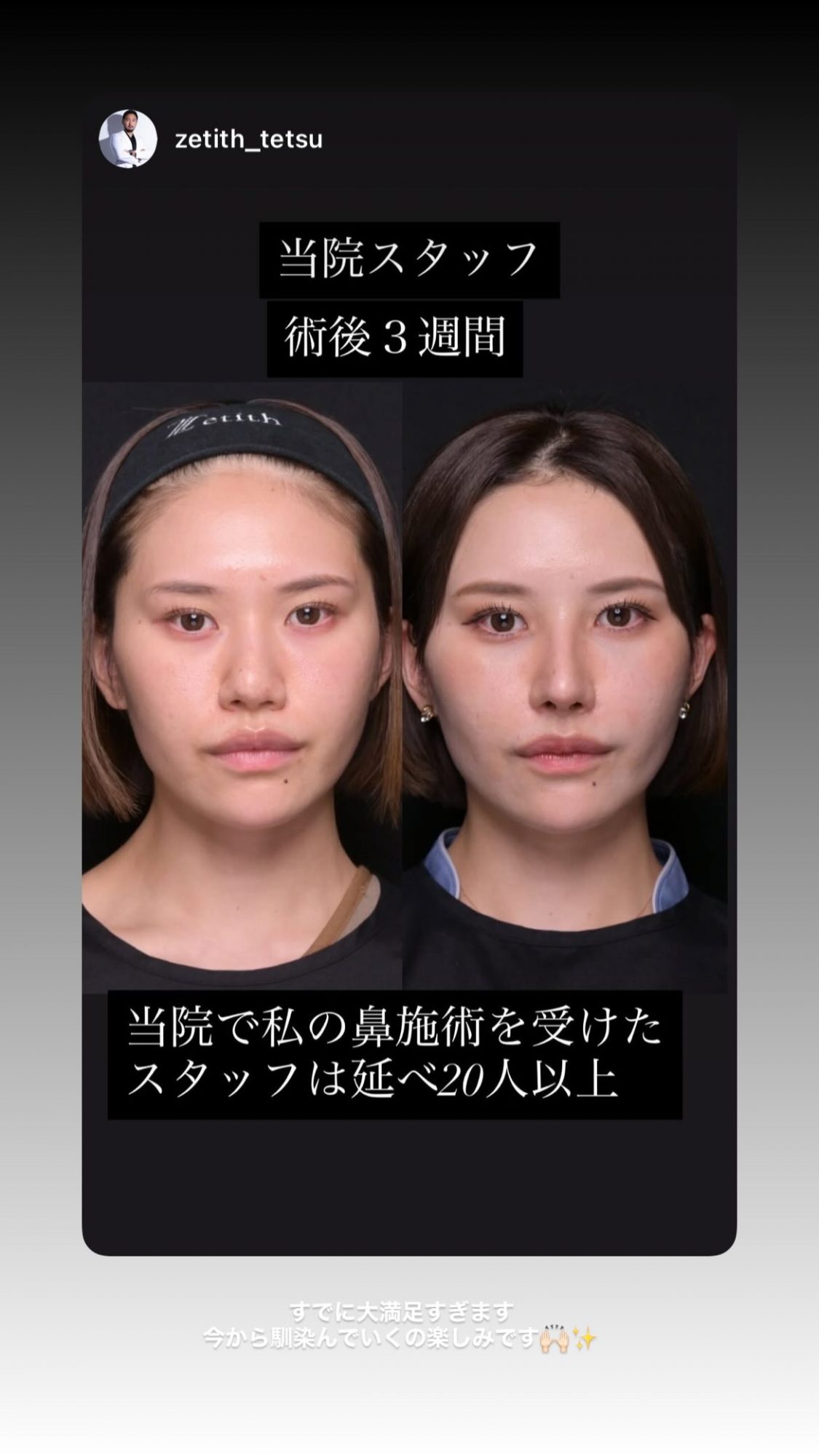 鼻整形3週間後