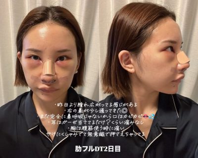 鼻整形2日目