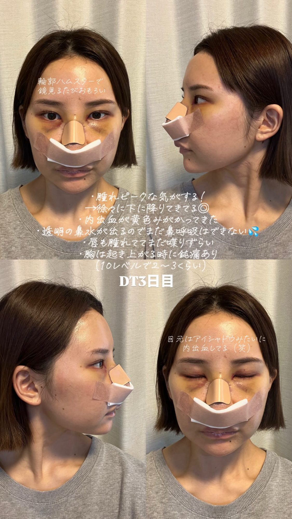 鼻整形3日目