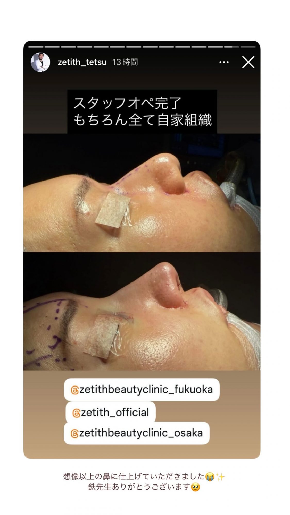 鼻整形術直後