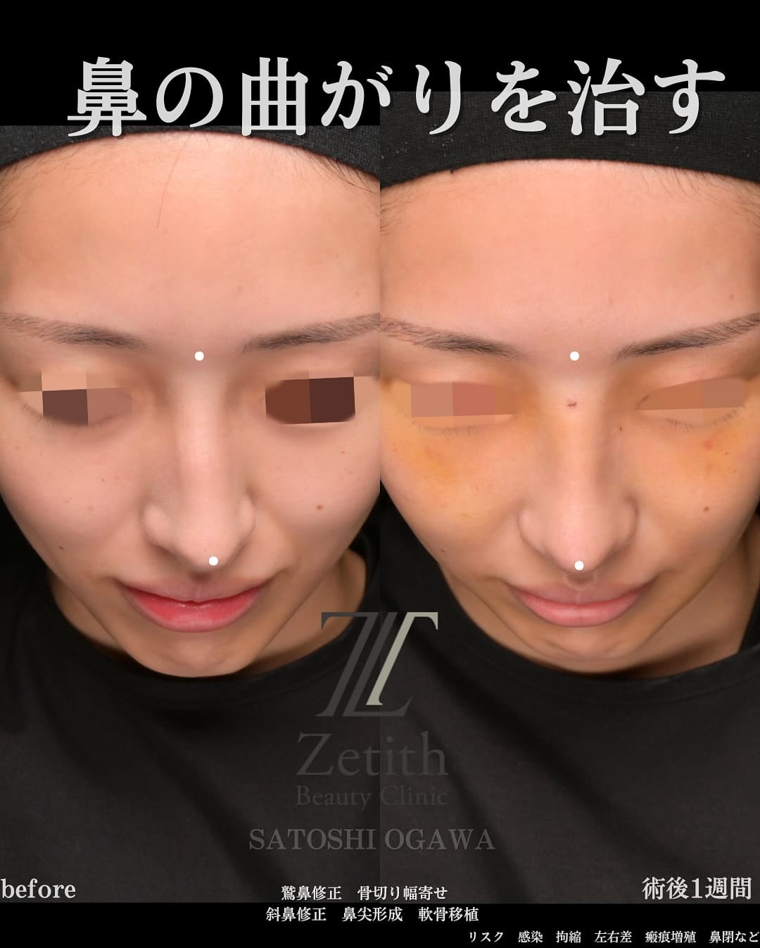 鼻整形のビフォーアフター写真(術前)