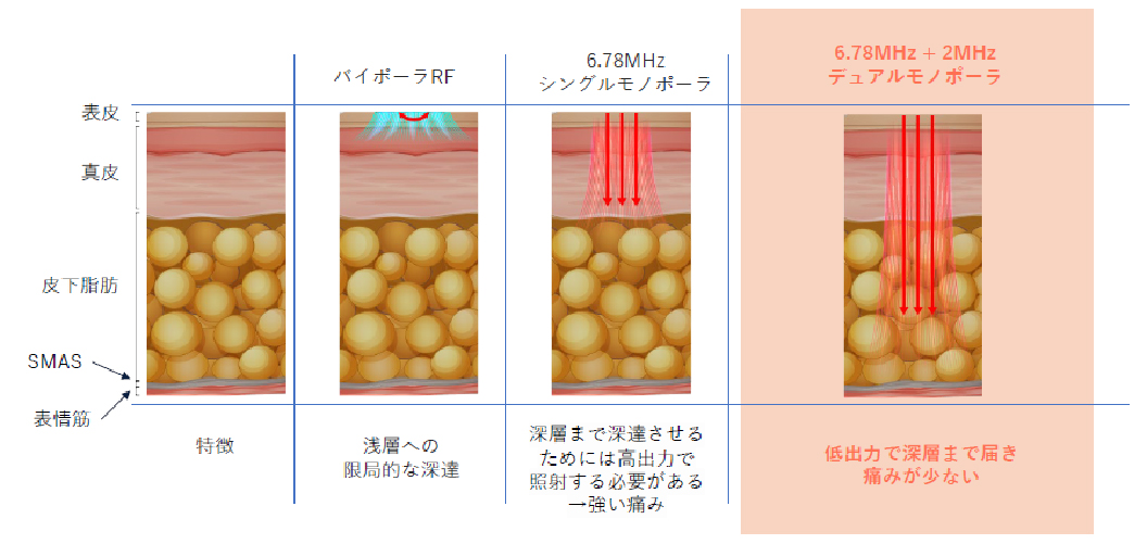 RFたるみ治療機では主流の6.78MHzと2MHzという周波数を同時照射が可能。 同時照射の技術により脂肪層の深部にまで熱エネルギーを届けることができ引き締め効果に加えリフトアップ効果も実感できる機械です。