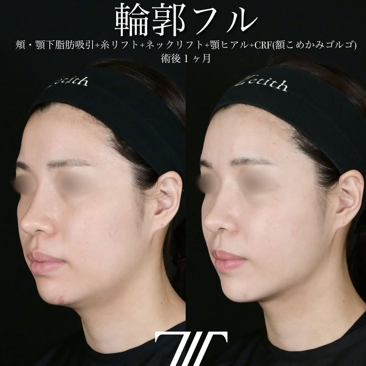 脂肪吸引リフトビフォーアフター写真