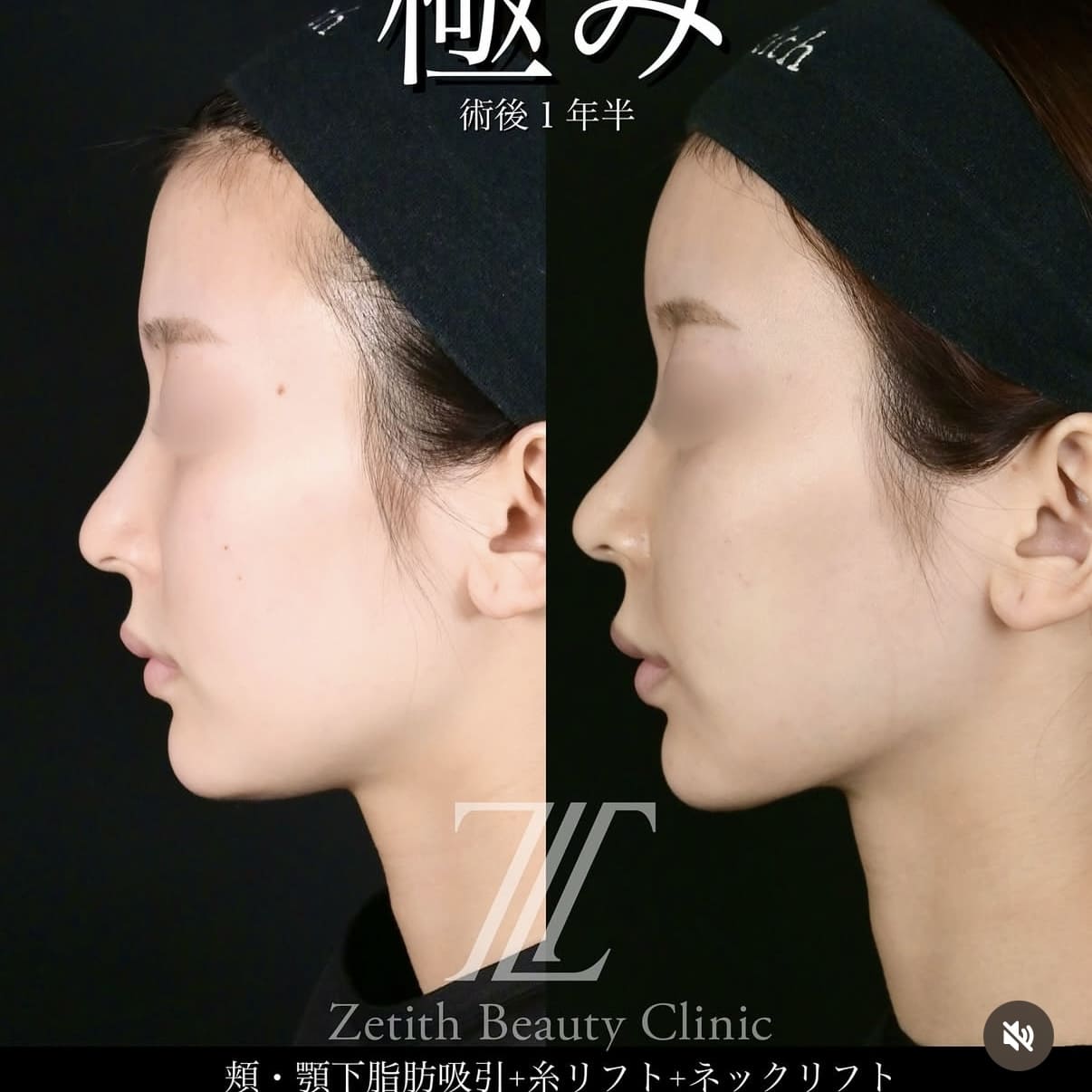 脂肪吸引リフトビフォーアフター写真
