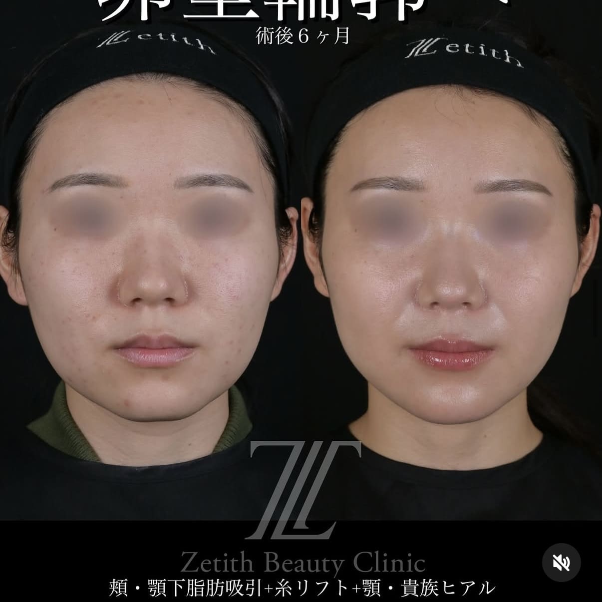 脂肪吸引リフトビフォーアフター写真