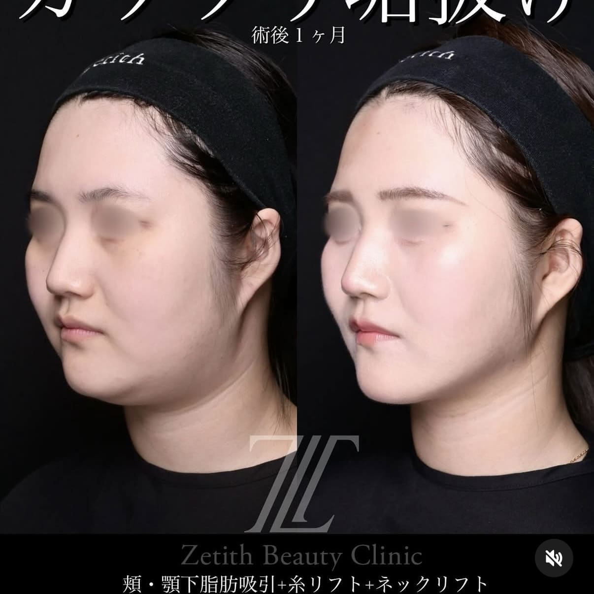脂肪吸引リフトビフォーアフター写真