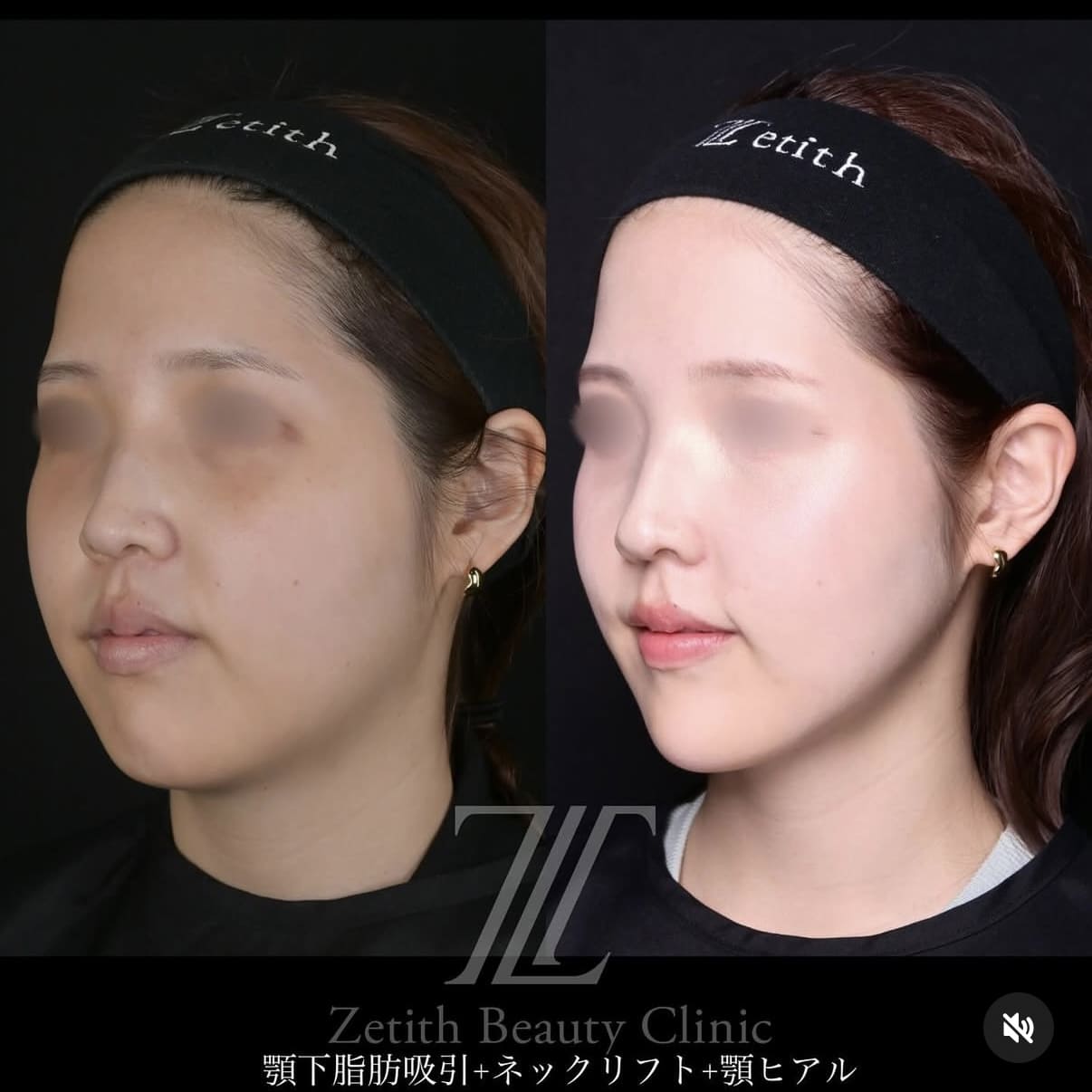 脂肪吸引リフトビフォーアフター写真