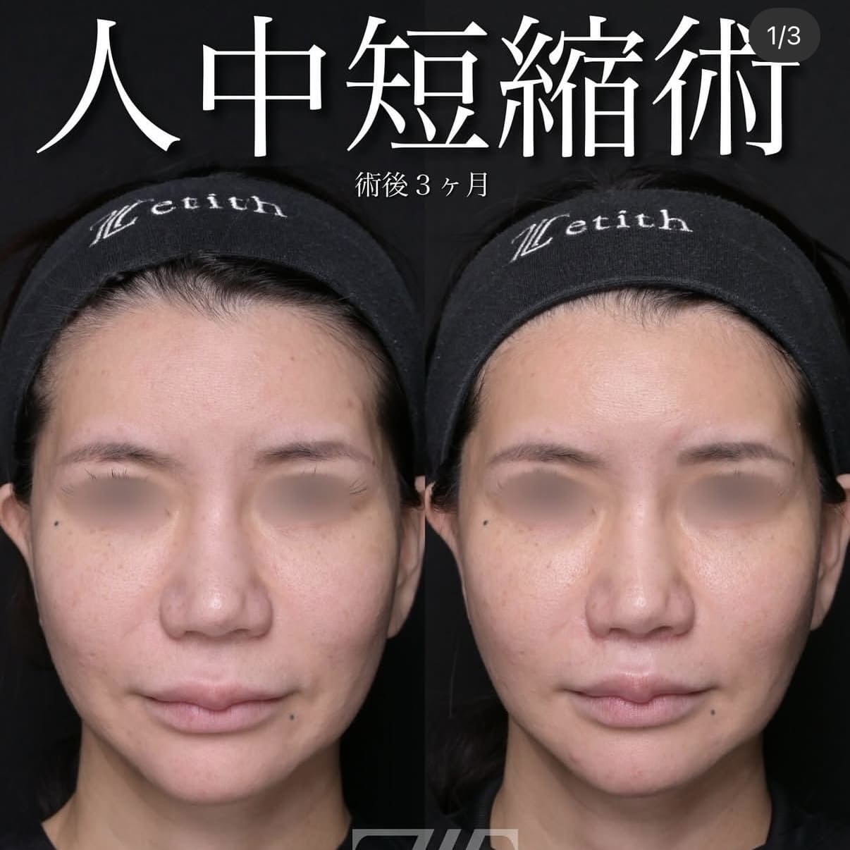 人中短縮ビフォーアフター写真