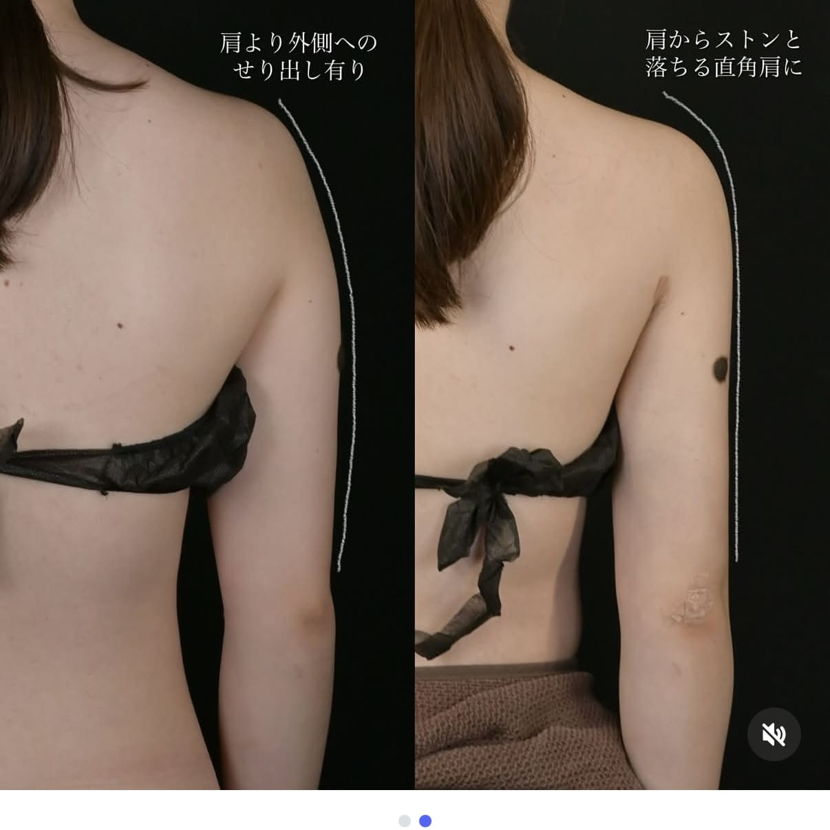 脂肪吸引ビフォーアフター写真