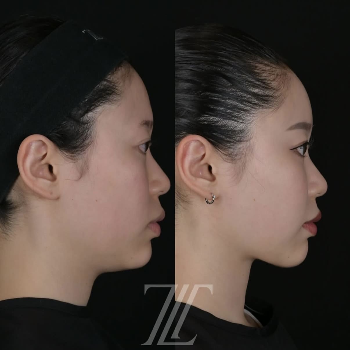 脂肪吸引リフト/脂肪注入ビフォーアフター写真