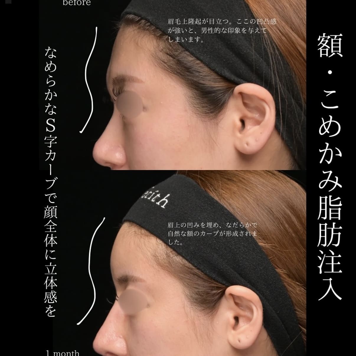 脂肪注入のビフォーアフター写真