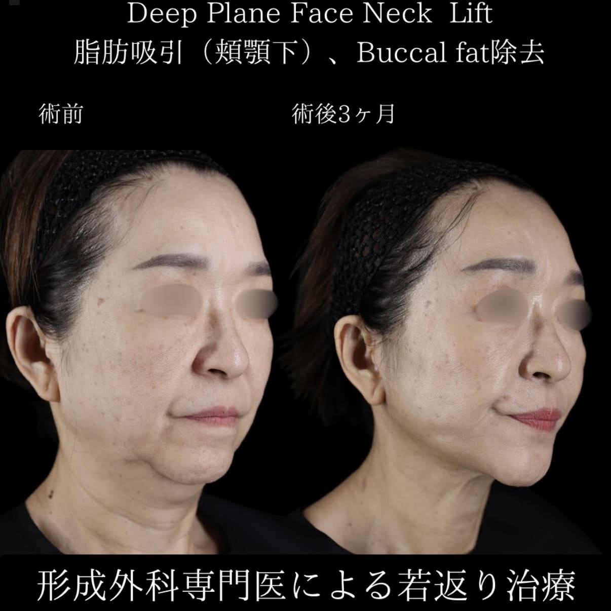 フェイスリフトのビフォーアフター写真