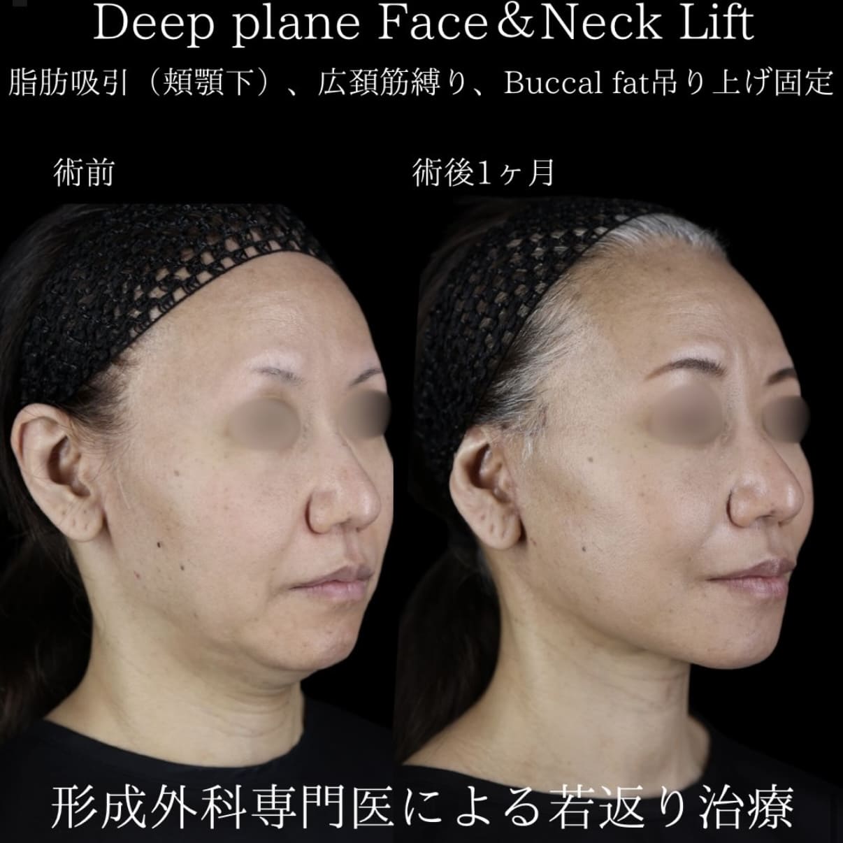 フェイスリフトのビフォーアフター写真