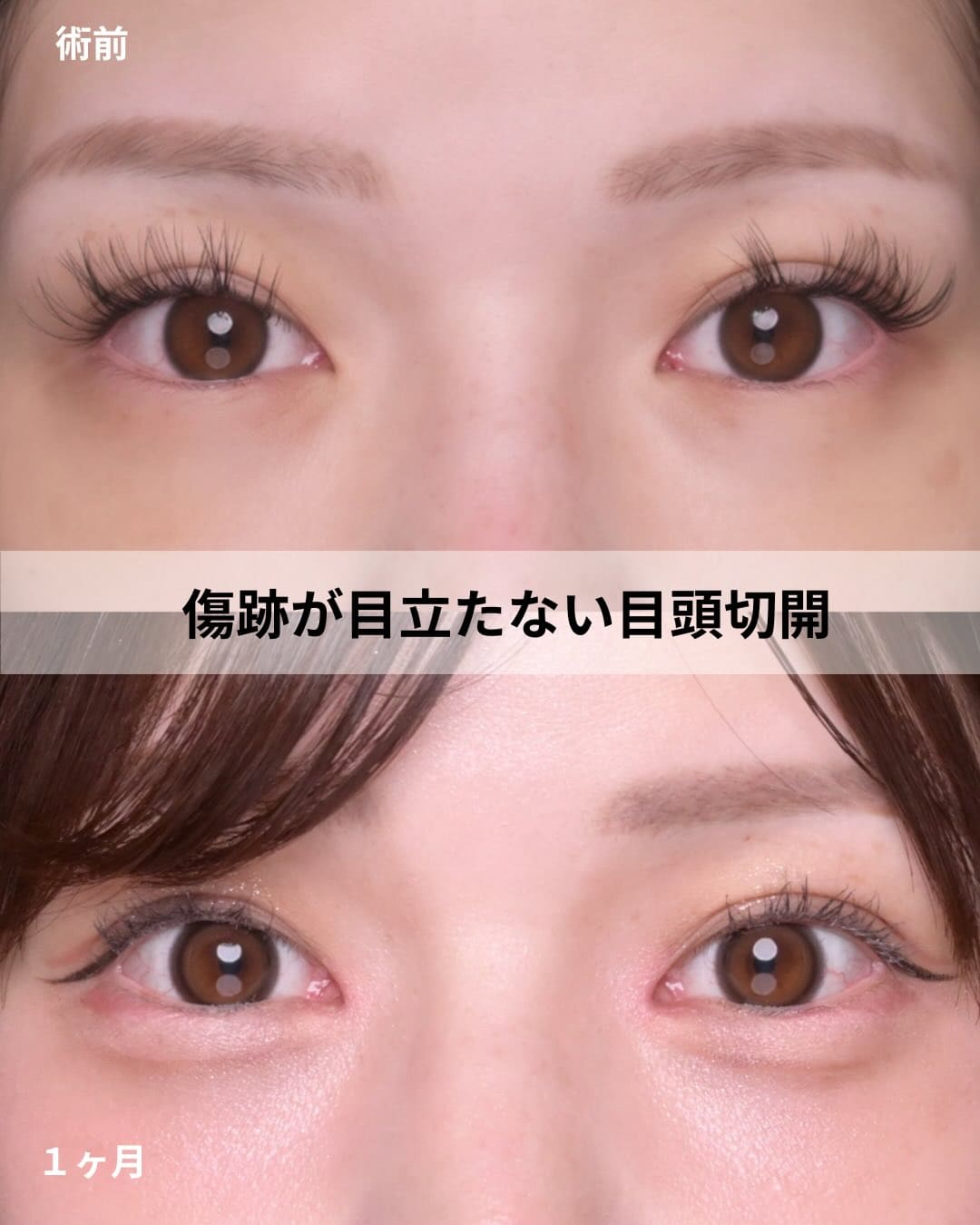 目整形のビフォーアフター写真(術前)