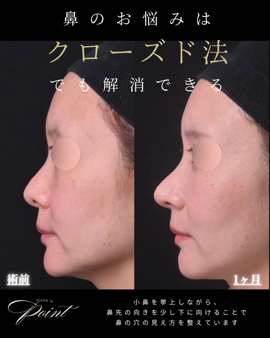 鼻整形 - ゼティスビューティークリニック｜鼻整形・鼻形成、美肌専門