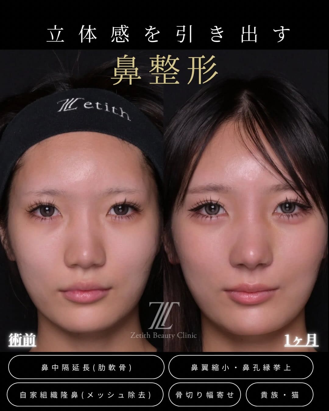 鼻整形のビフォーアフター写真(術前)