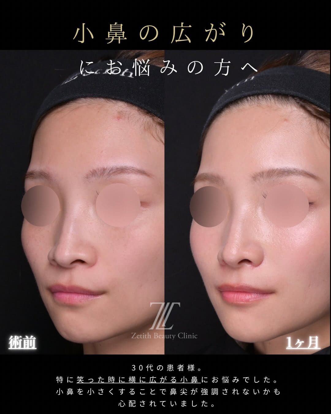 鼻整形 - ゼティスビューティークリニック｜鼻整形・鼻形成、美肌専門