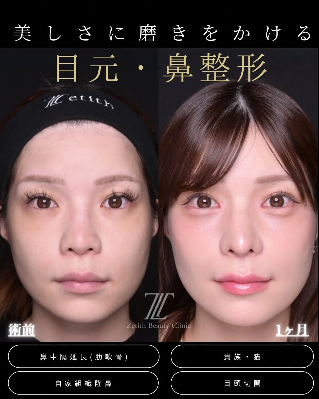 鼻整形 - ゼティスビューティークリニック｜鼻整形・鼻形成、美肌専門